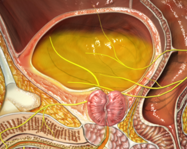 Urine retention due to enlarged prostate